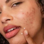 Dermalogica Post-Breakout Fix — гель-крем для лікування плям після висипань 15 мл
