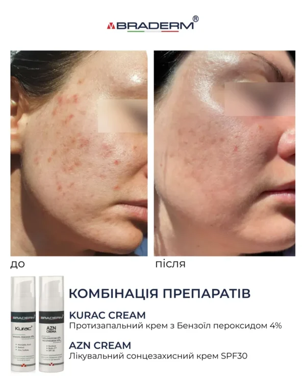 Braderm Kurac Cream — активний протизапальний крем з бензоїл пероксидом 4% 30 мл