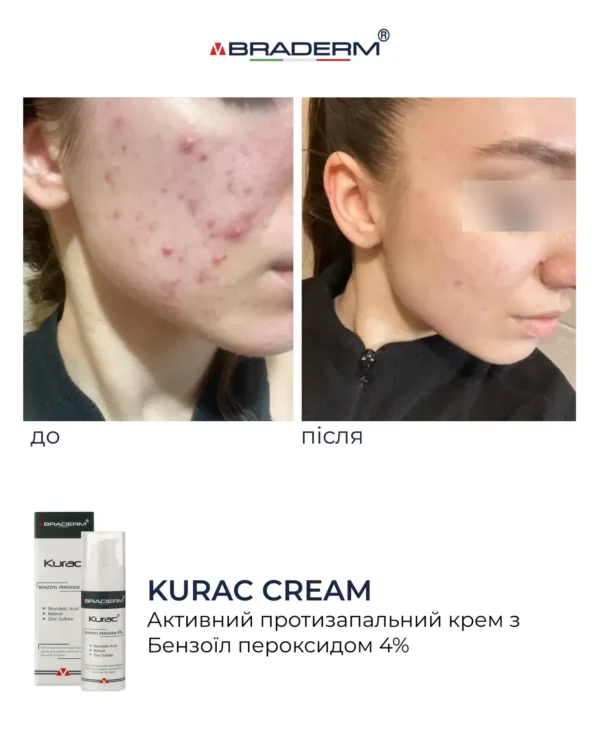 Braderm Kurac Cream — активний протизапальний крем з бензоїл пероксидом 4% 30 мл
