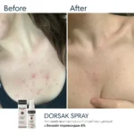 Braderm Dorsak Spray — активний спрей від акне на тілі з бензоїл пероксидом 6% 100 мл
