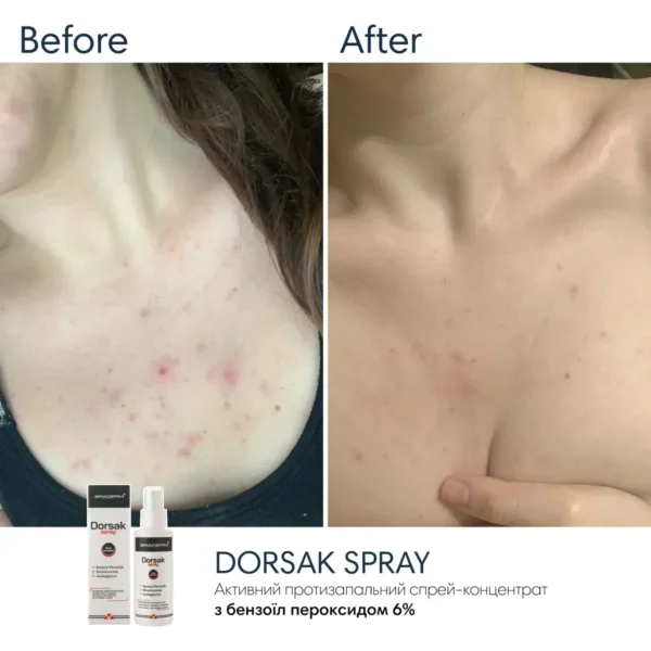 Braderm Dorsak Spray — активний спрей від акне на тілі з бензоїл пероксидом 6% 100 мл