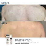 Braderm Dorsak Spray — активний спрей від акне на тілі з бензоїл пероксидом 6% 100 мл