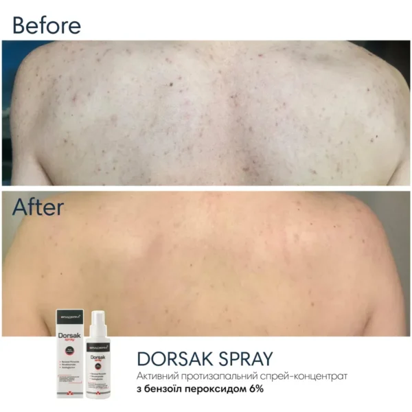 Braderm Dorsak Spray — активний спрей від акне на тілі з бензоїл пероксидом 6% 100 мл
