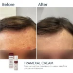 Braderm Tramexal Cream — освітлювальна емульсія проти пігментації 30 мл