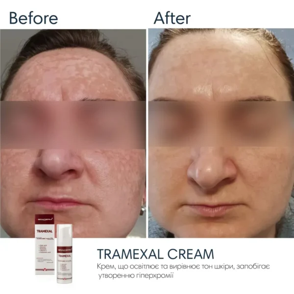 Braderm Tramexal Cream — освітлювальна емульсія проти пігментації 30 мл