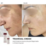 Braderm Tramexal Cream — освітлювальна емульсія проти пігментації 30 мл