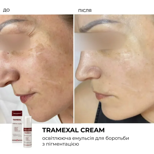Braderm Tramexal Cream — освітлювальна емульсія проти пігментації 30 мл