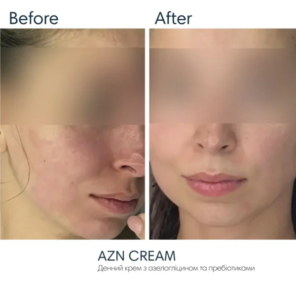 Braderm AZN Cream SPF 30 — сонцезахисний крем з протизапальним ефектом 30 мл