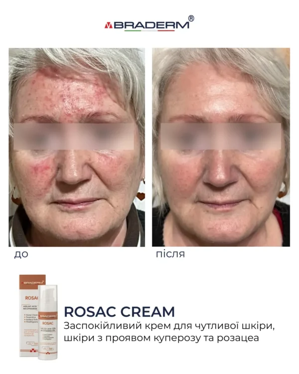 Braderm Rosac Cream — заспокійливий крем для чутливої шкіри 30 мл