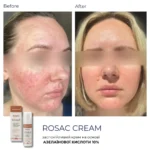 Braderm Rosac Cream — заспокійливий крем для чутливої шкіри 30 мл