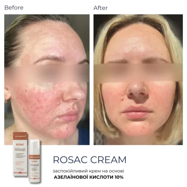 Braderm Rosac Cream — заспокійливий крем для чутливої шкіри 30 мл